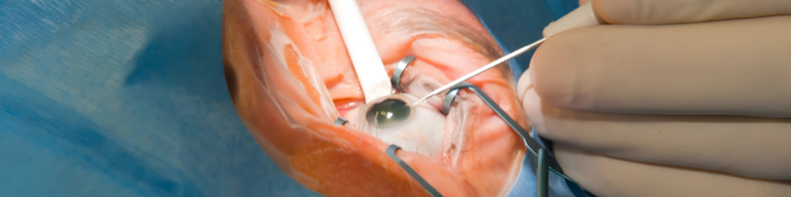 Multifocal Lens Implantation